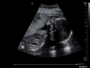 Week 22 Ultrasound